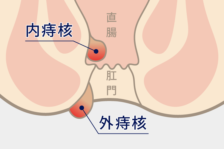 いぼ痔（内痔核、外痔核）
