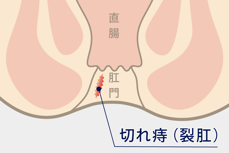 裂肛