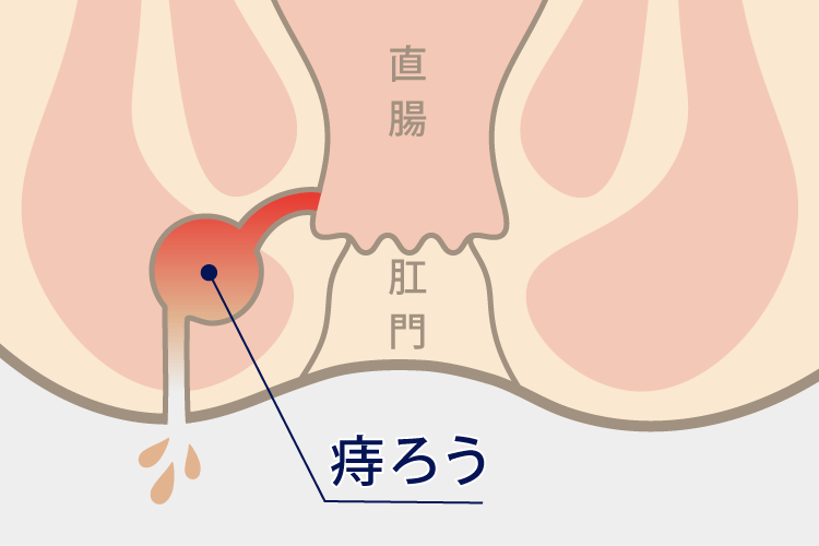 あな痔（痔瘻）